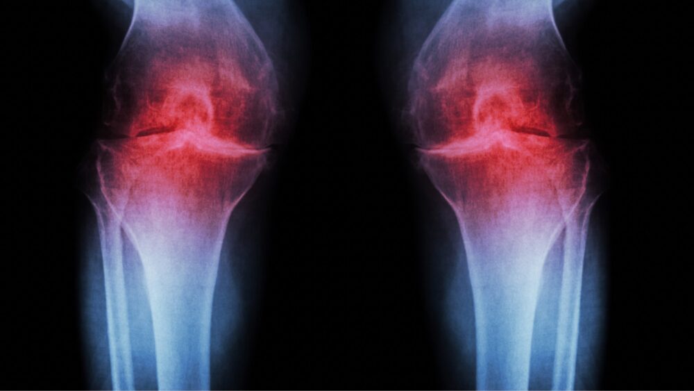 Bild von ausgeprägter Arthrose