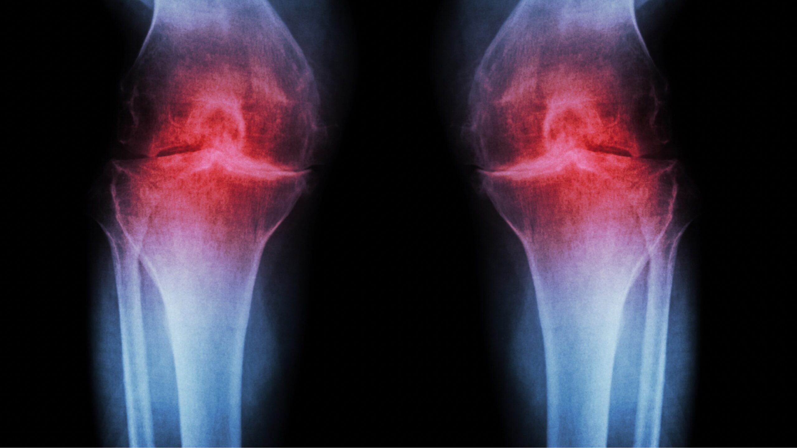 Bild von ausgeprägter Arthrose